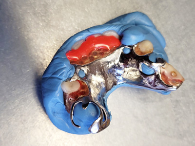 réparation prothèse dentaire à Florennes